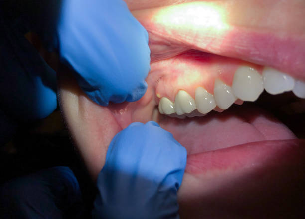 Best Emergency Gum Treatment in Wood River, NE